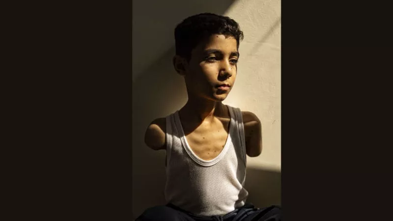 Fotografia e 9-vjeçarit palestinez të amputuar fiton World Press Photo 2025
