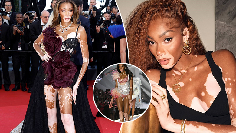 Winnie Harlow: Një vajzë e bullizuar si fëmijë që për pak la shkollën – ndërsa sot një modele e klasit botëror dhe sipërmarrëse e suksesshme