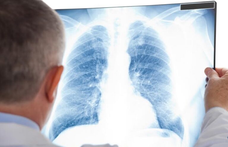 Tuberkulozi mbetet sfidë, vetëm vitin që shkoi u regjistruan 548 raste