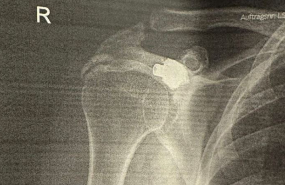 Plumbi që mbijetoi 27 vjet në trupin tim” – rrëfimi i Gramoz Berishës në 18-vjetorin e Pavarësisë