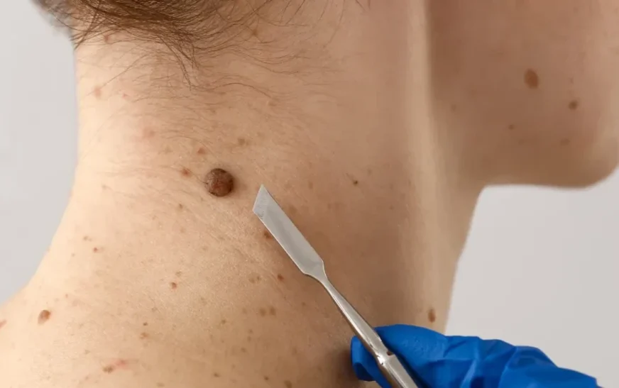 Pse disa njerëz kanë shumë nishane