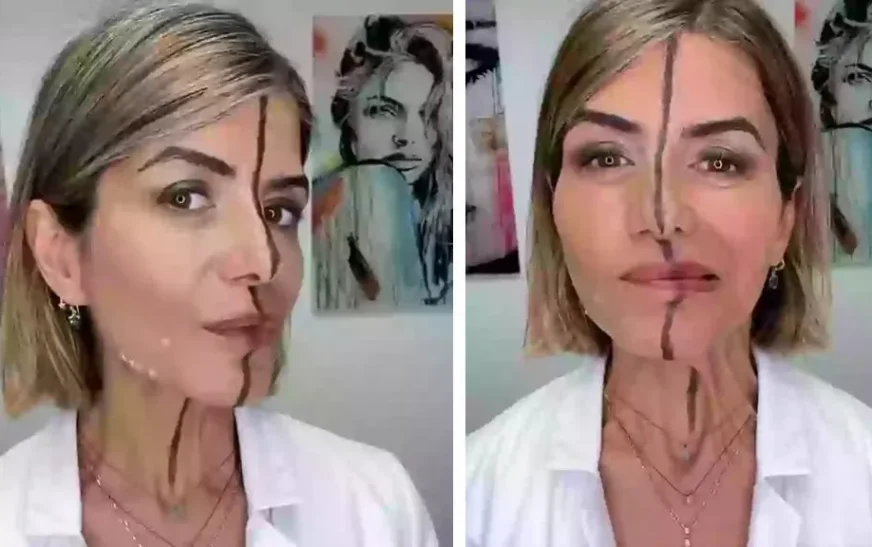 Eksperimenti i pazakontë i mjekes: Botoksi vetëm në një anë të ballit tregon ndryshimin e dukshëm