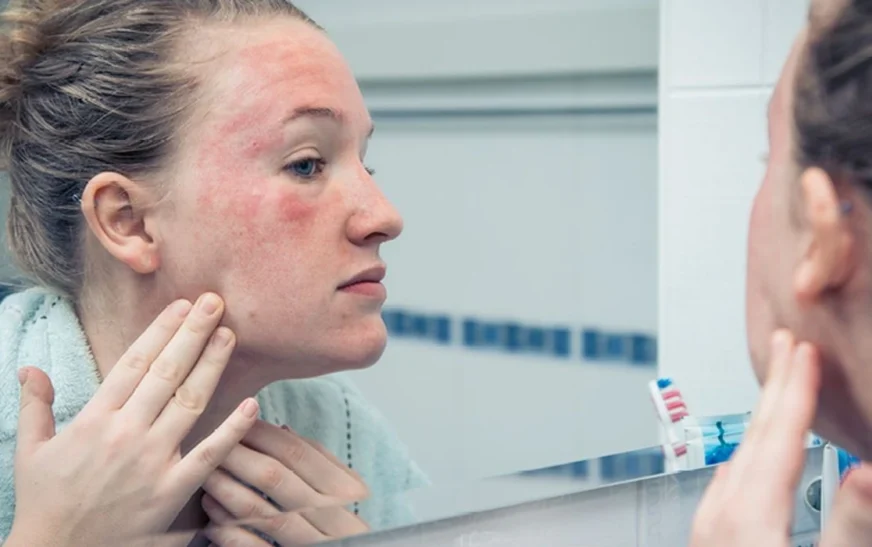 Stresi kronik mund t’ju ndezë lëkurën: Shkencëtarët zbulojnë si shfaqet ekzema