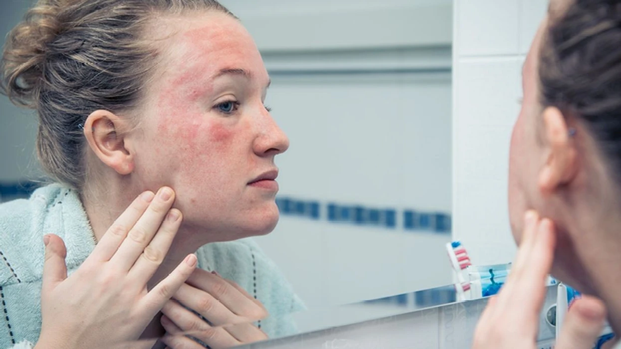 Stresi kronik mund t’ju ndezë lëkurën: Shkencëtarët zbulojnë si shfaqet ekzema