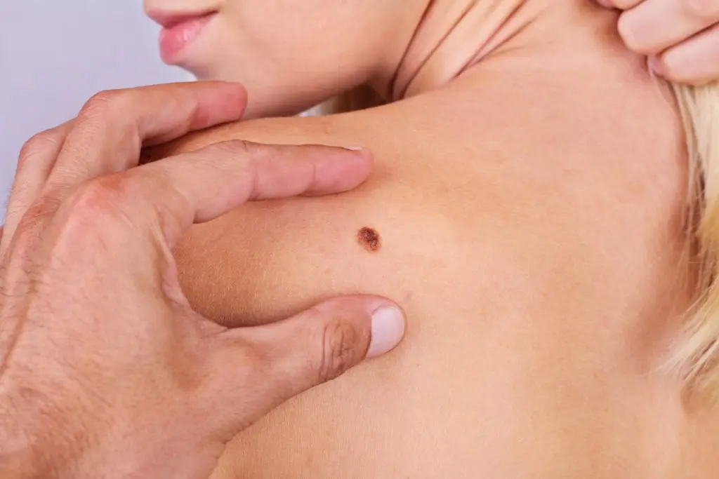 Vaksina eksperimentale me mRNA ul me 42% rrezikun e rikthimit të melanomës