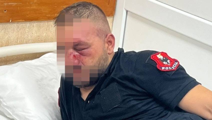 Nëntë policë marrin trajtim në Traumë pas protestës, njëri me lëndime të rënda në fytyrë –